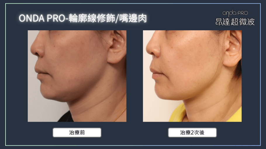 onda-case-face-3