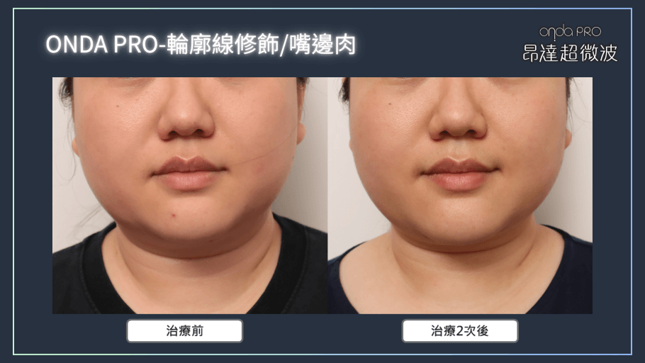 onda-case-face-4