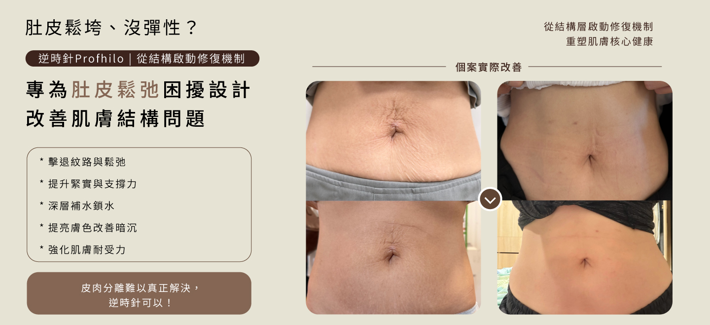 逆時針 肚皮鬆弛 案例