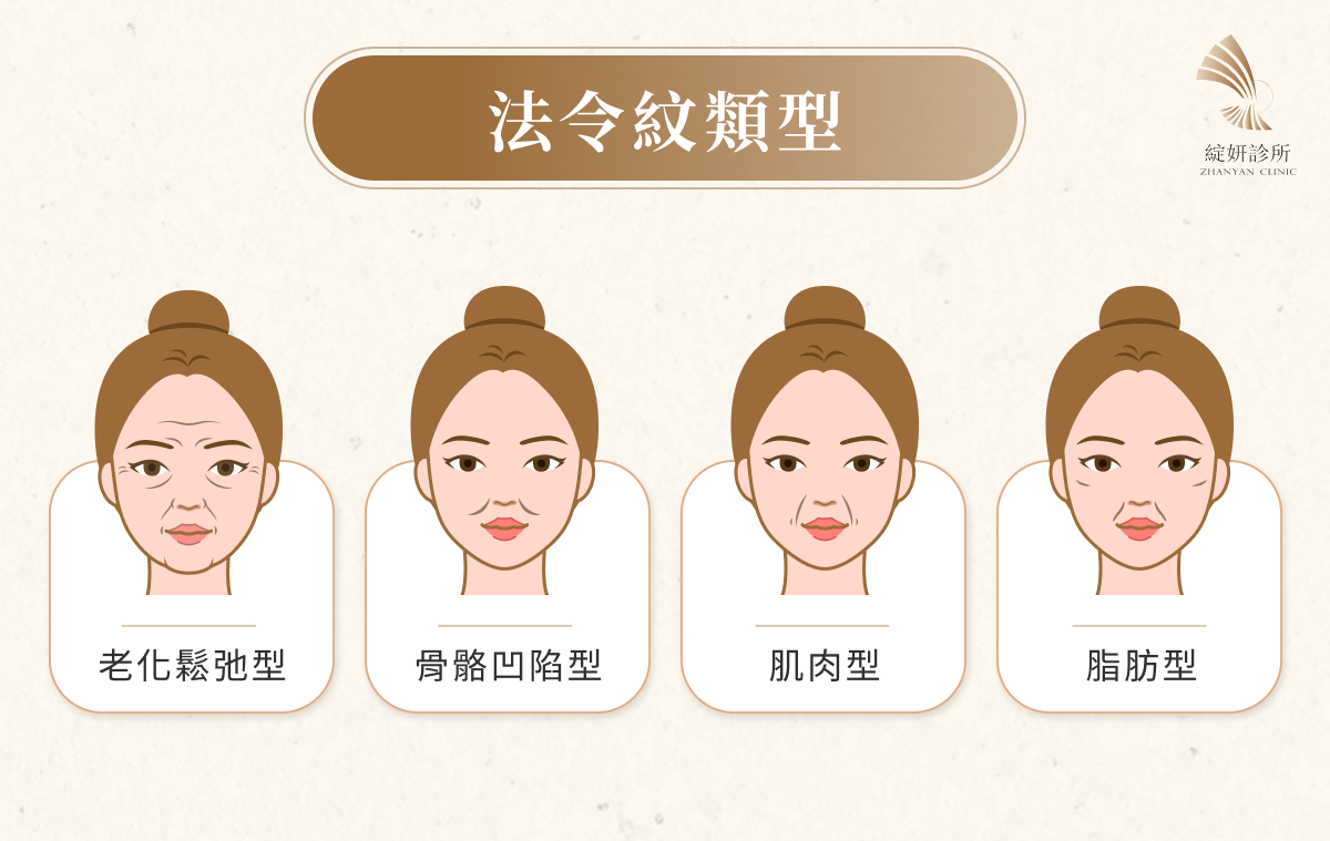 法令紋類型