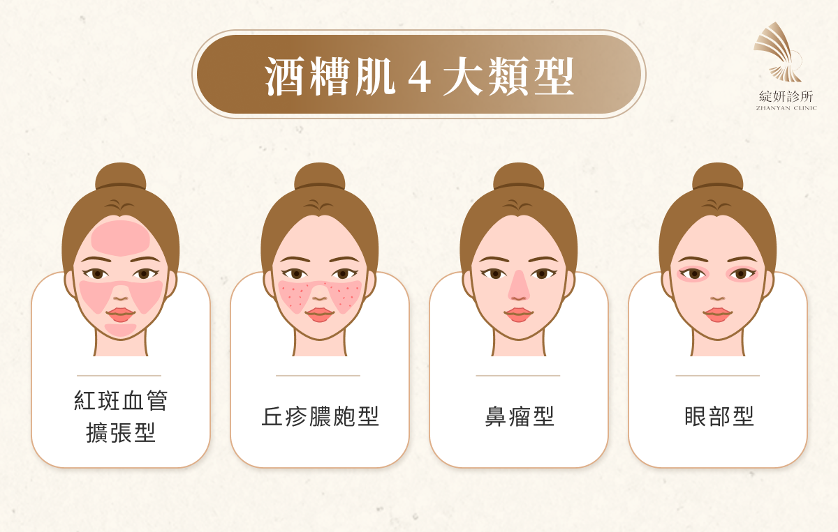 酒糟肌4大類型