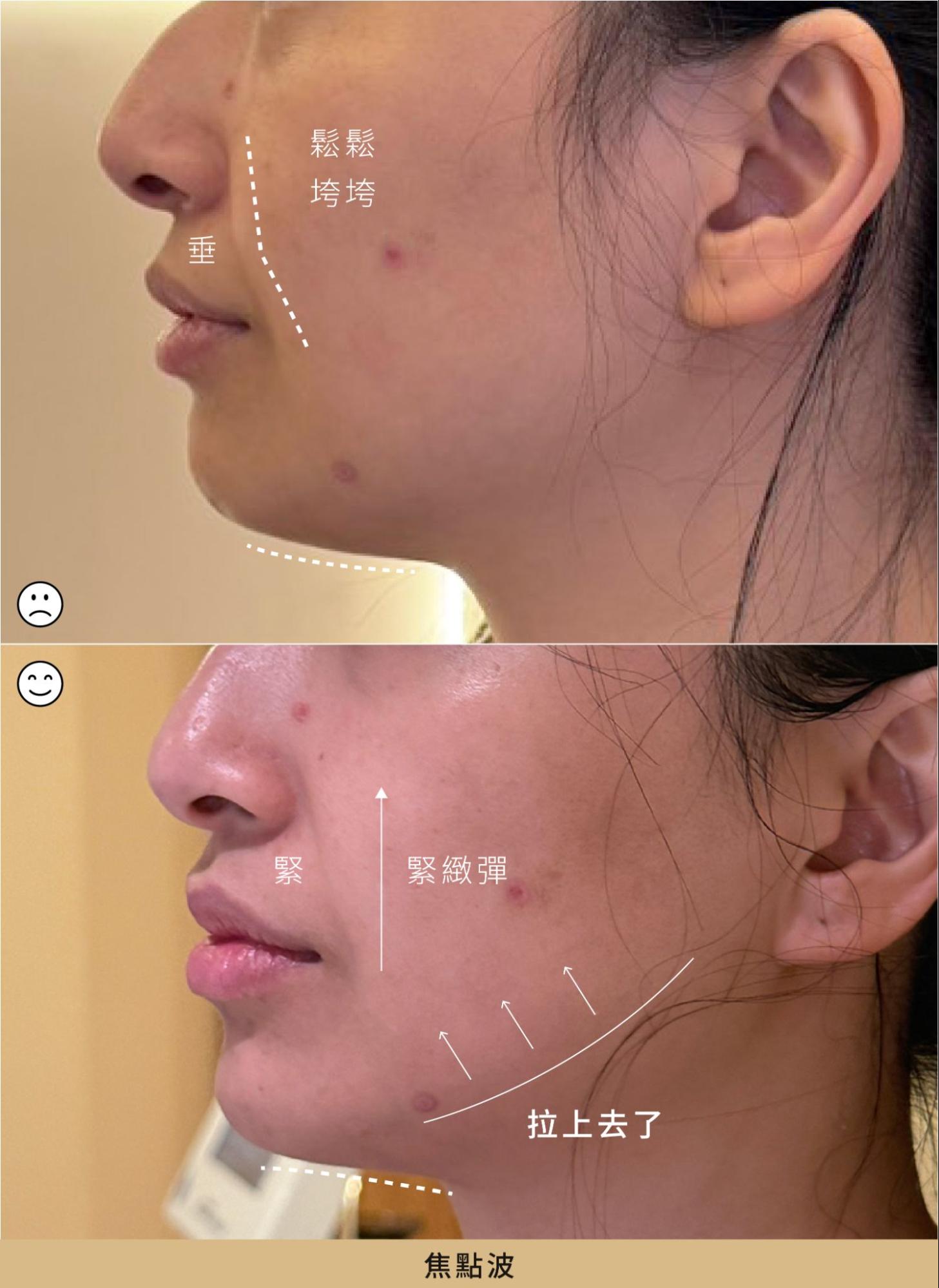 案例 1:焦點波療程
