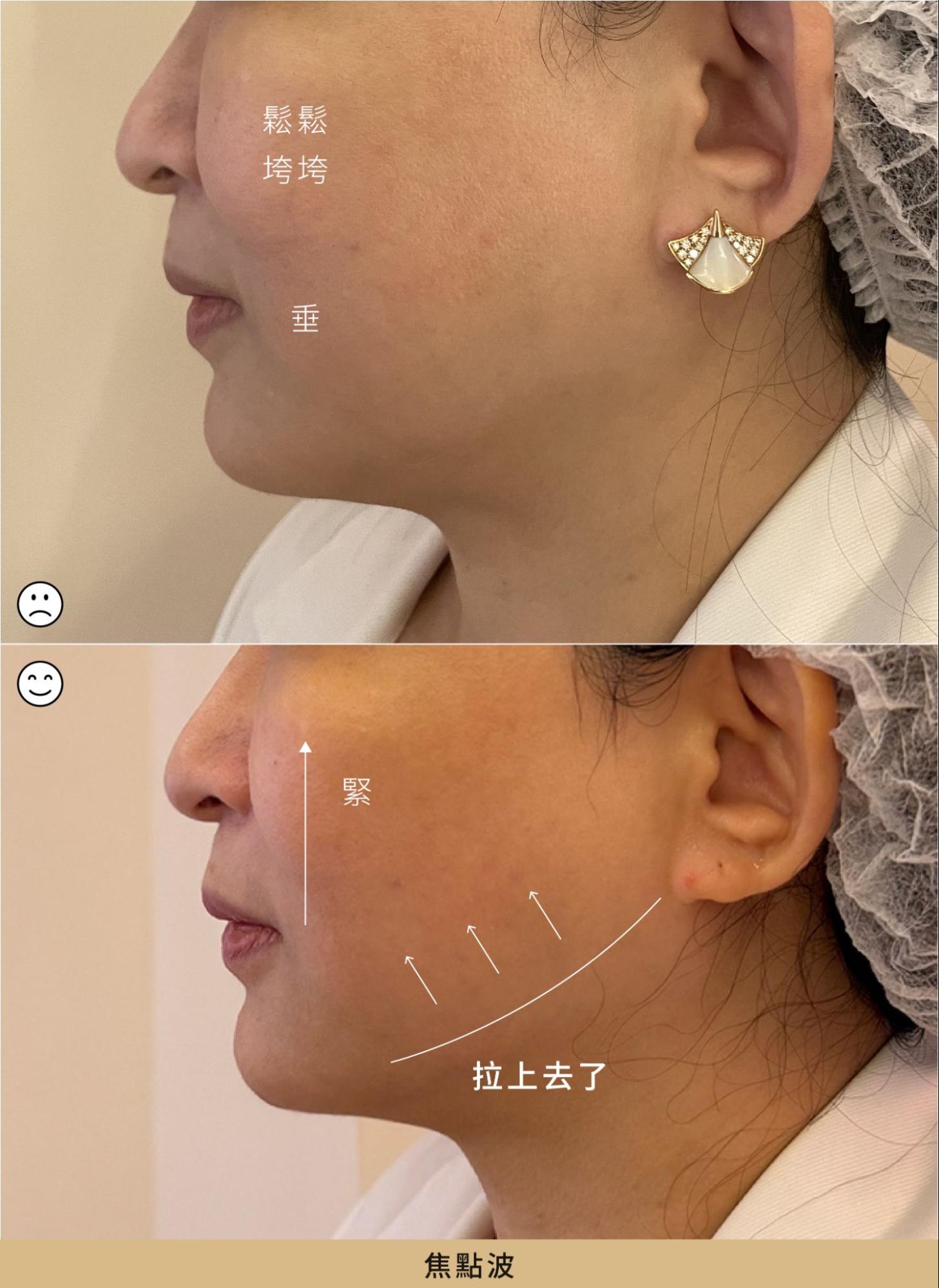 案例 2:焦點波療程