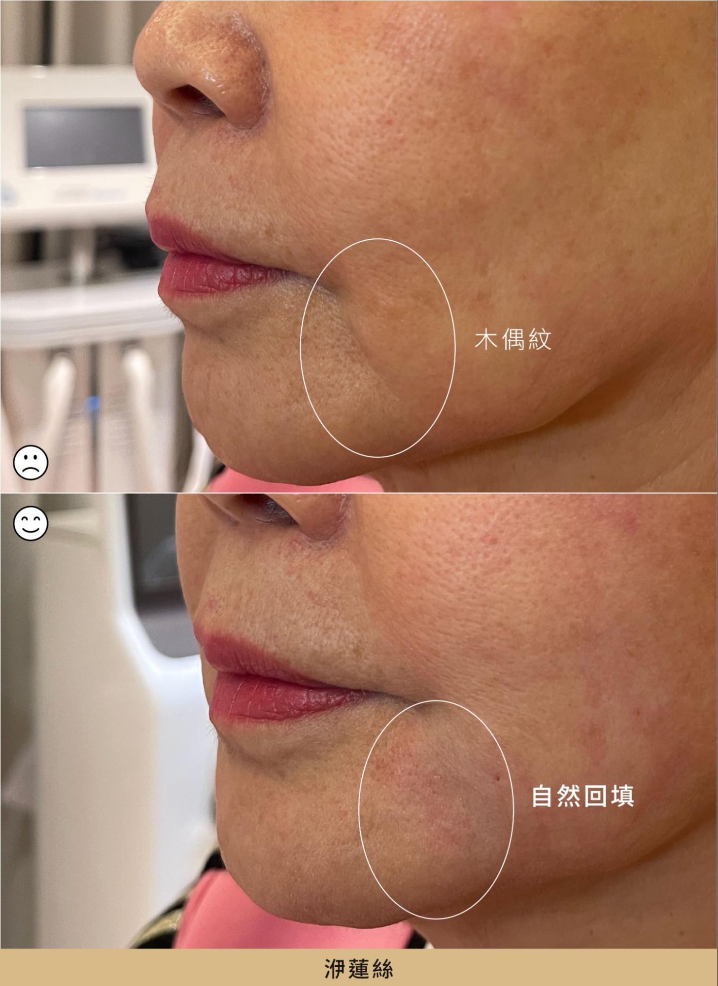 案例 3:洢蓮絲療程