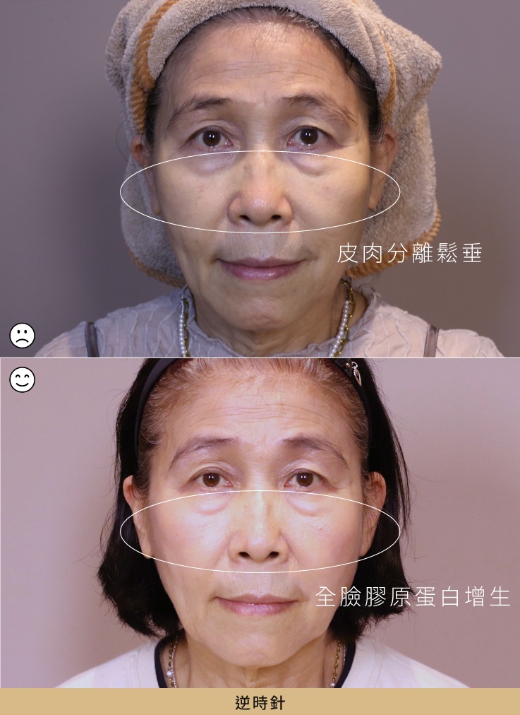 逆時針案例