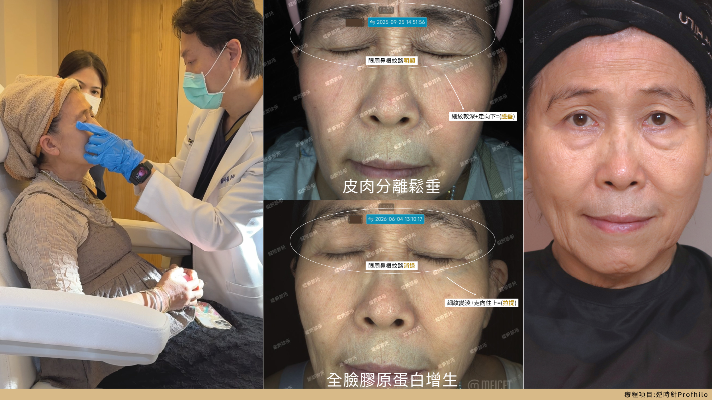 逆時針療程案例分析，術前可見皮肉分離與細紋，術後肌膚細緻度、飽滿度、水潤感及膚色均勻度提升。