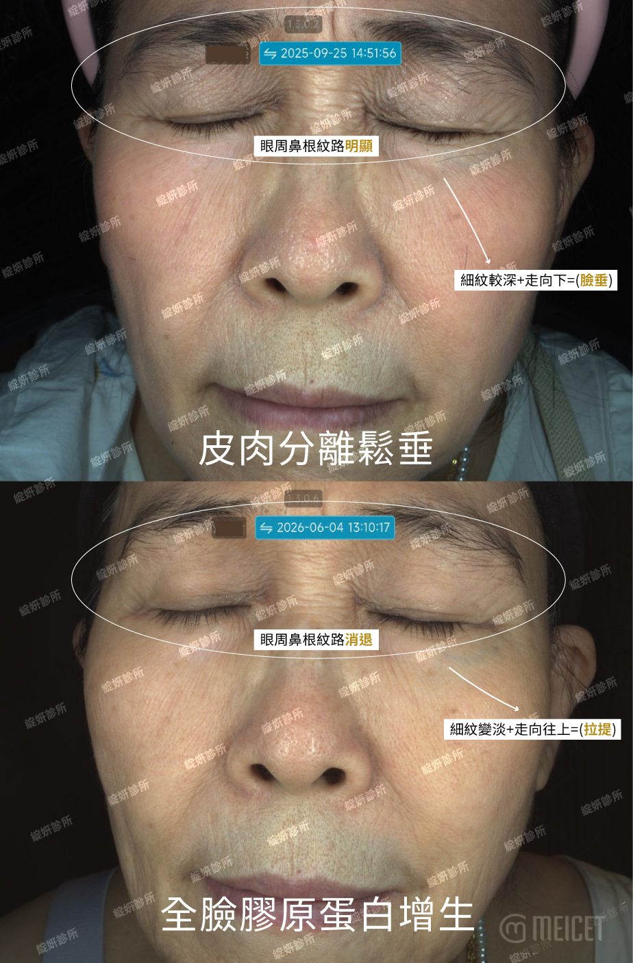 逆時針療程案例分析，術前可見皮肉分離與細紋，術後肌膚細緻度、飽滿度、水潤感及膚色均勻度提升。