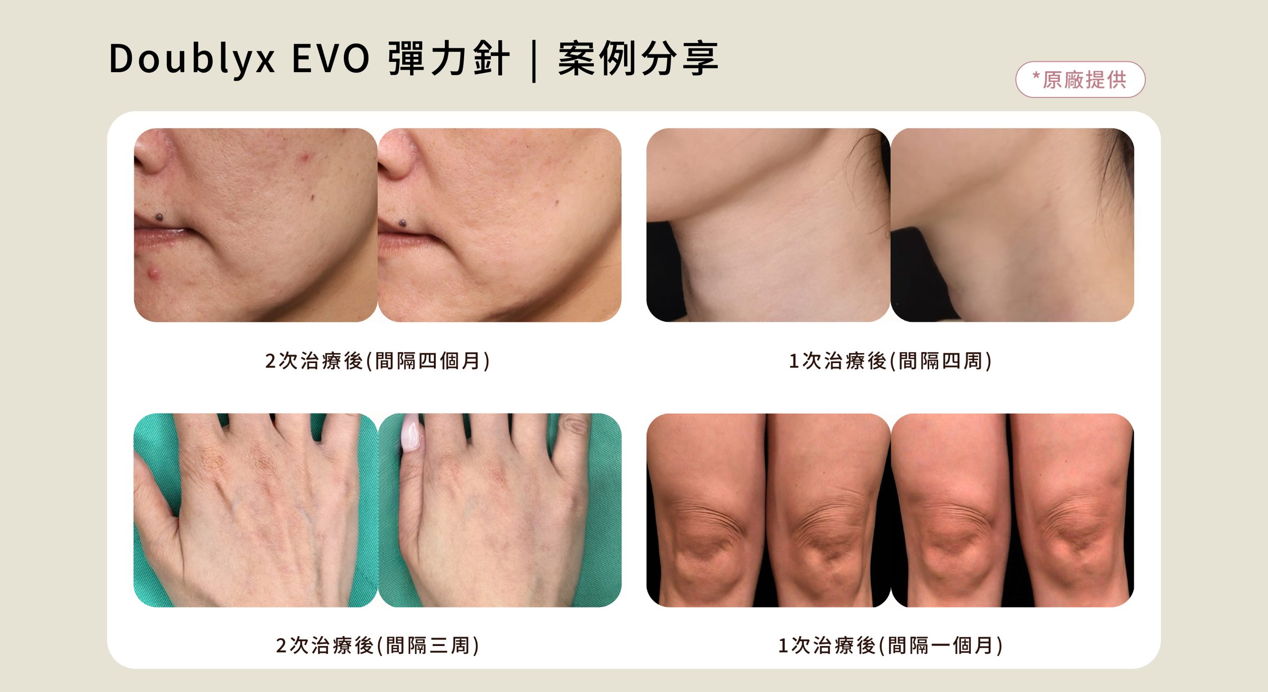 Doublyx EVO® 彈力針 案例照