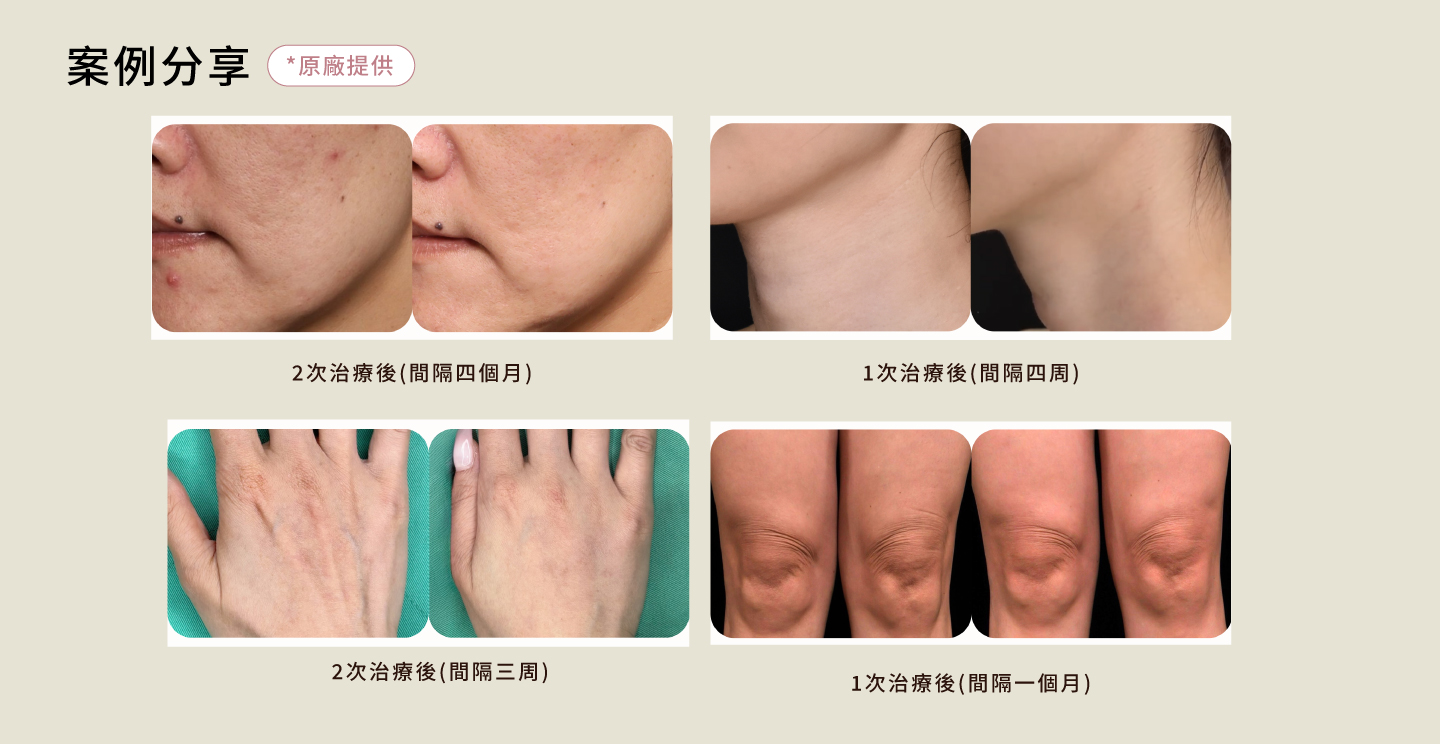 Doublyx EVO® 彈力針 案例照
