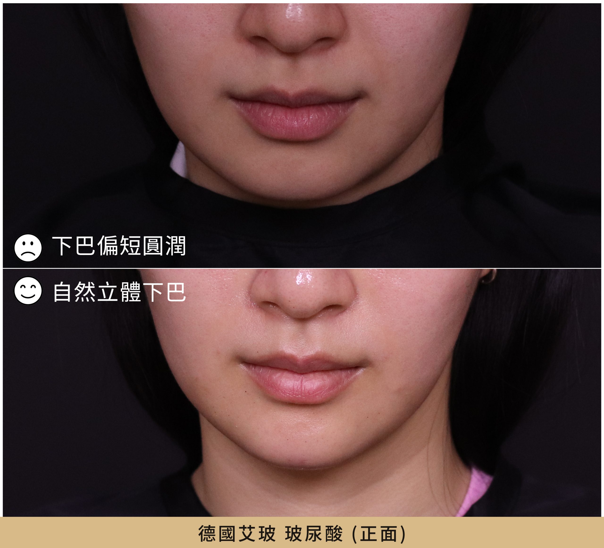 德國艾玻玻尿酸2支下巴輪廓雕塑正面案例