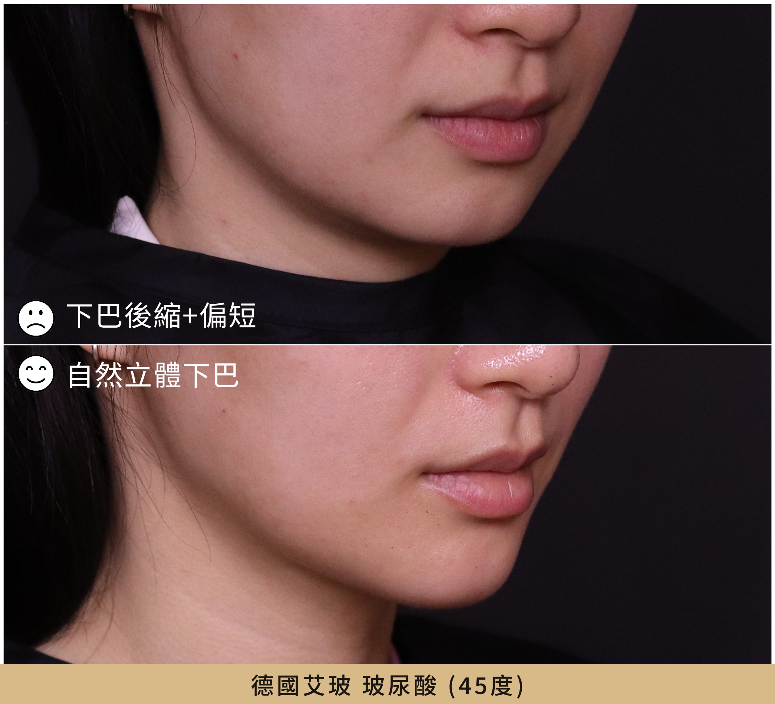下巴後縮德國艾玻玻尿酸45度輪廓案例