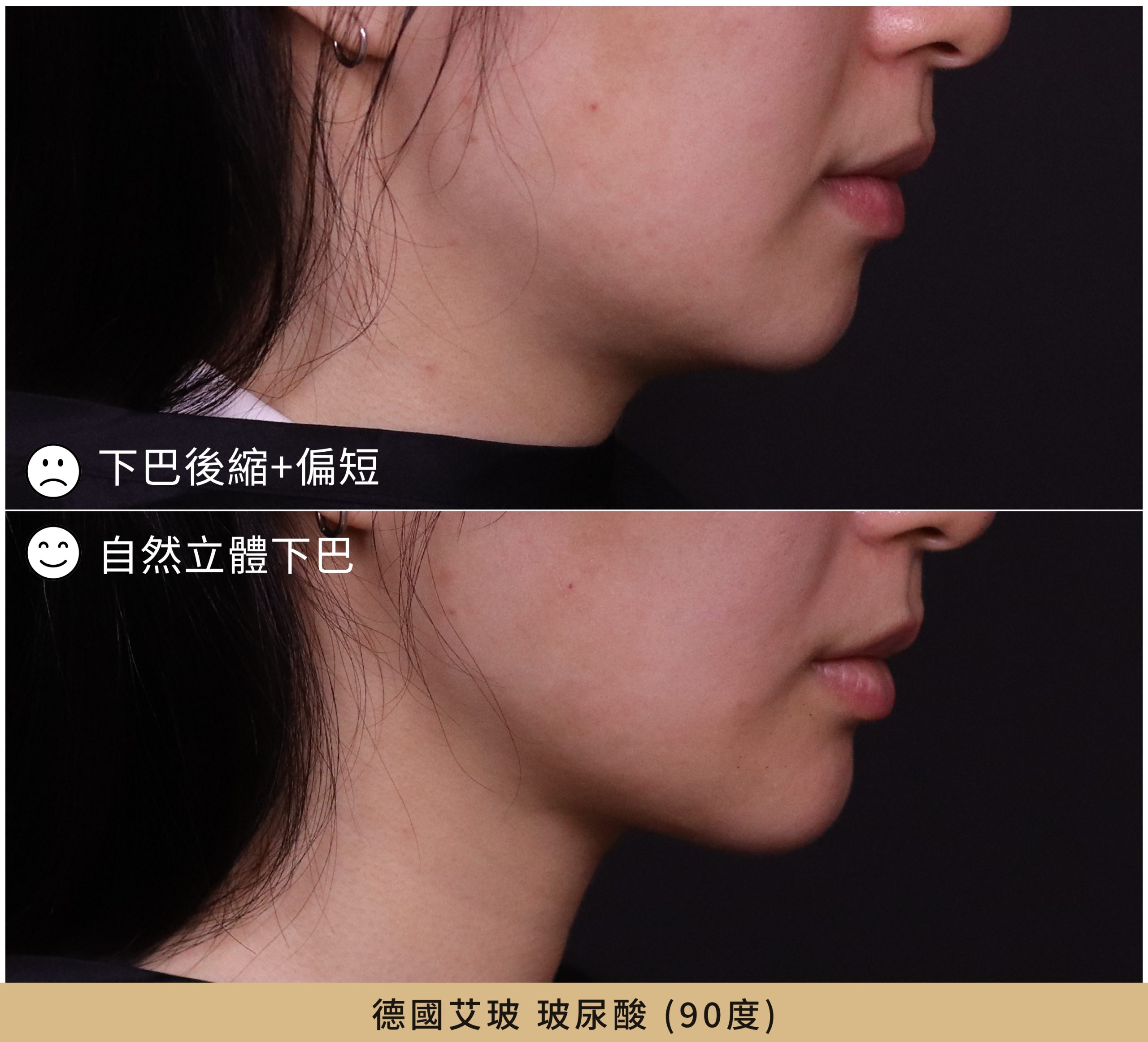 下巴後縮玻尿酸改善側面比例案例
